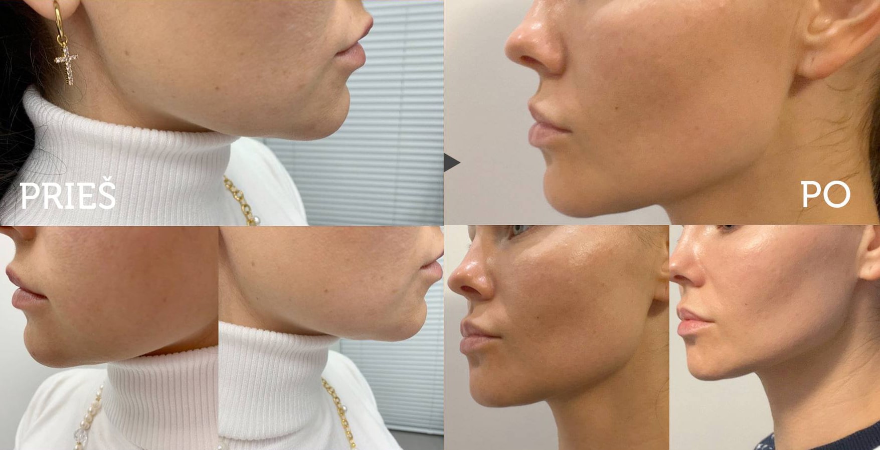 indre burlinskaite hifu horizontalus