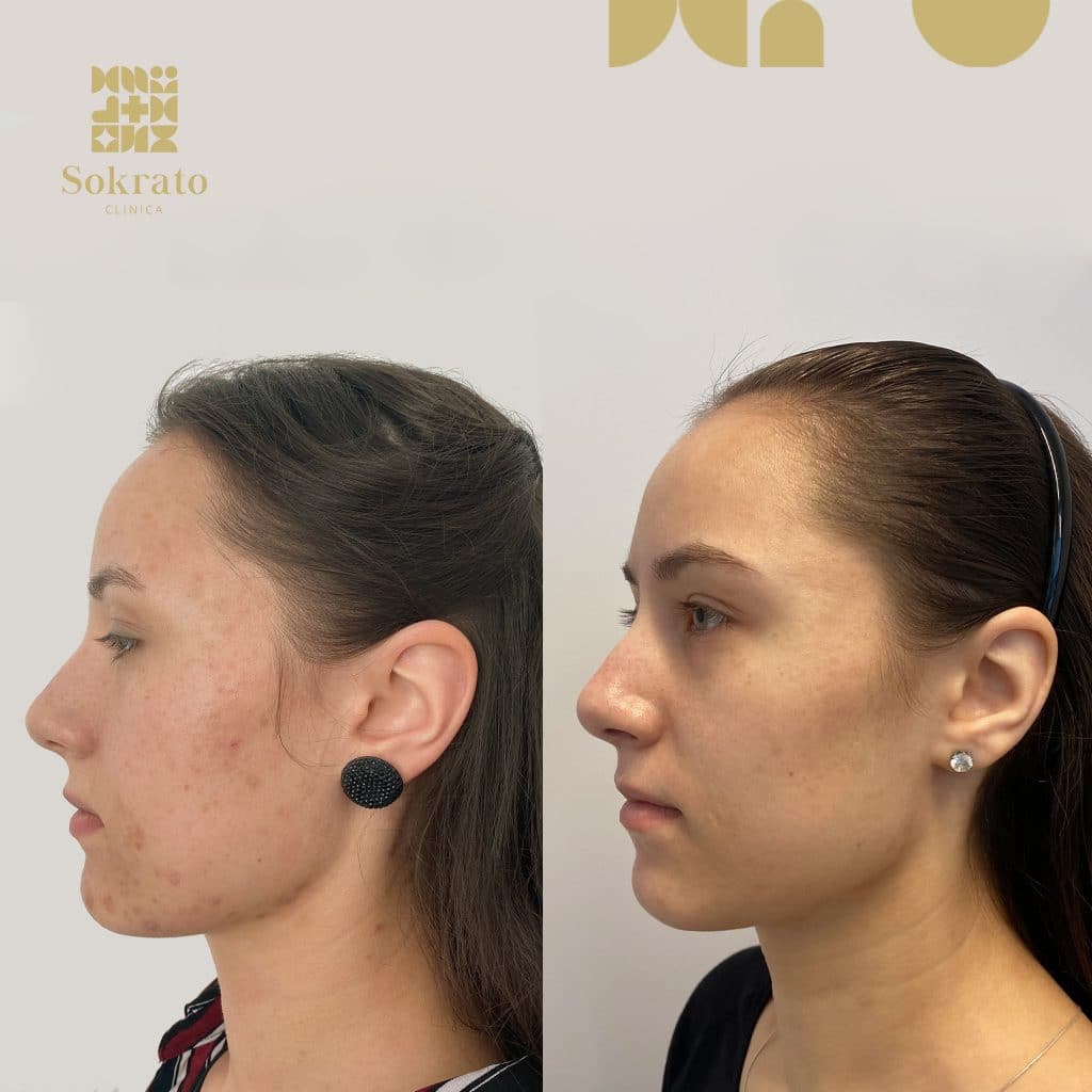 sokrato klinika aknes gydymas Gintare Linkeviciute